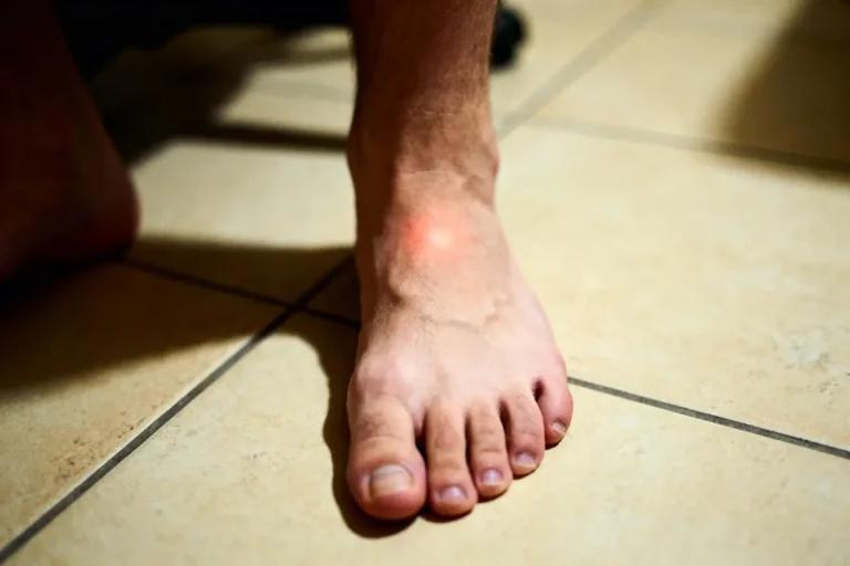 Pied avec une inflammation rouge sur la cheville, posé sur un carrelage beige.