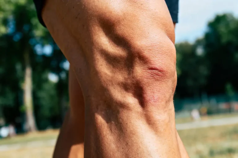 Gros plan sur un genou musclé et blessé, avec arrière-plan flou de parc verdoyant.