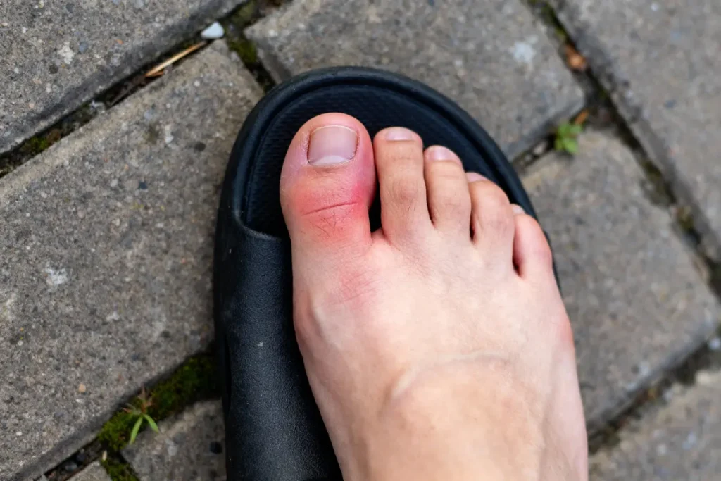 Pied en sandale noire, orteil gonflé et rouge sur pavé gris.