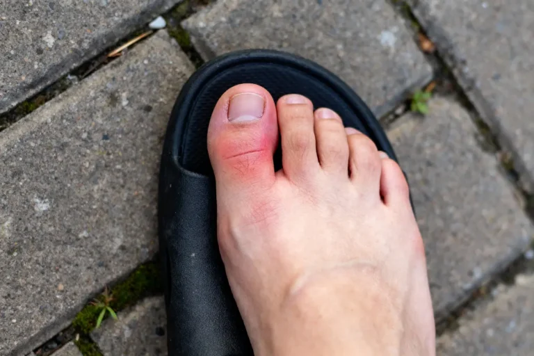 Pied en sandale noire, orteil gonflé et rouge sur pavé gris.