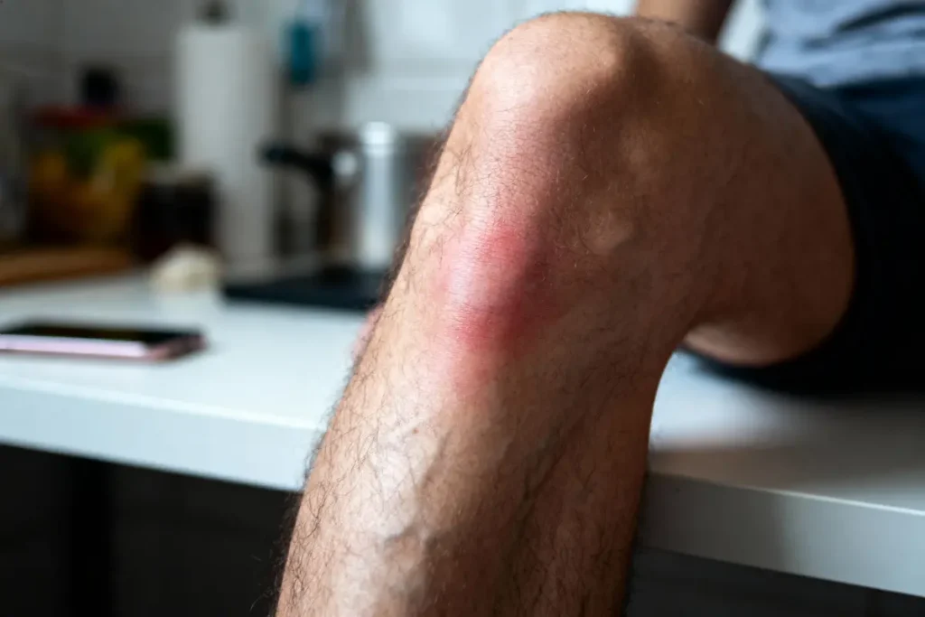 Genou enflé et rouge sur une jambe d'une personne, assise dans une cuisine.