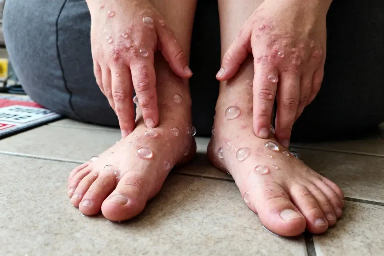 Personne montrant mains et pieds couverts de bulles et cloques sur sol carrelé.