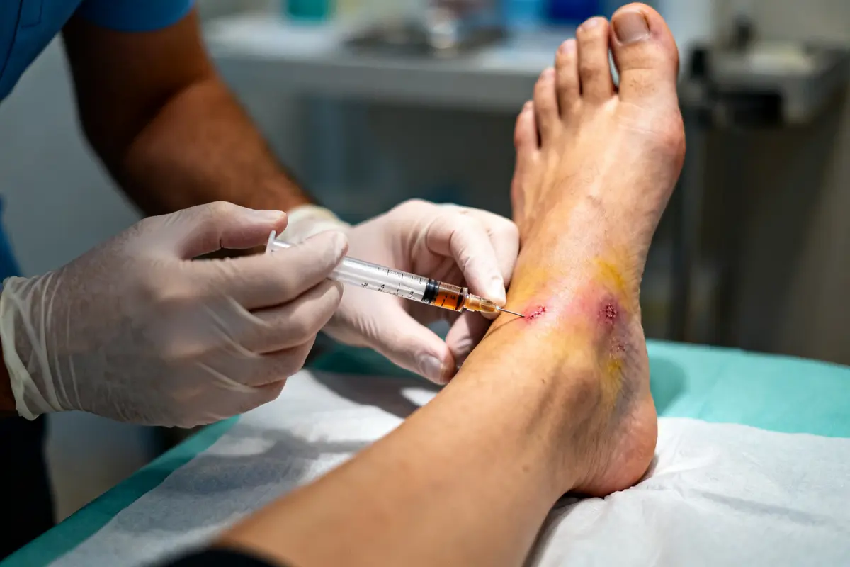 Infiltration bursite pied : Symptômes, traitements écho guidés ?