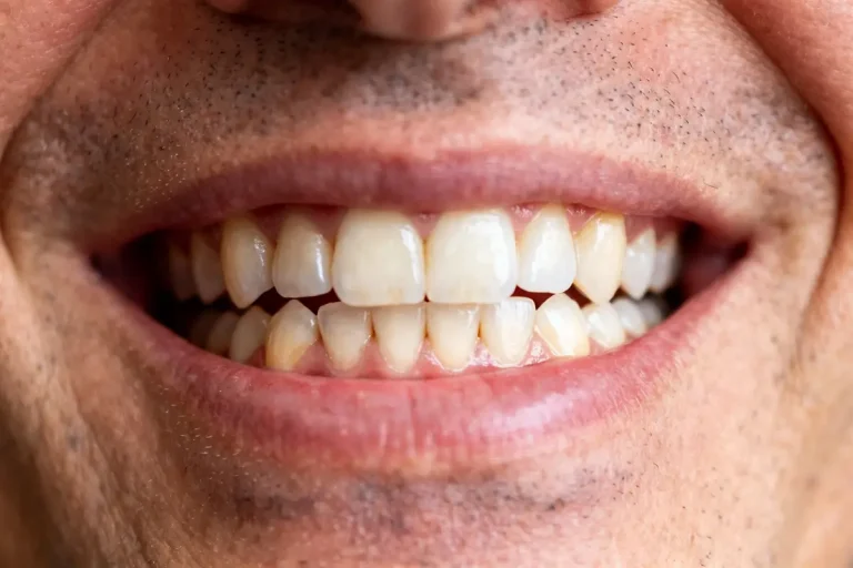 Sourire d'un adulte montrant nombre de dents adulte bien alignées et saines