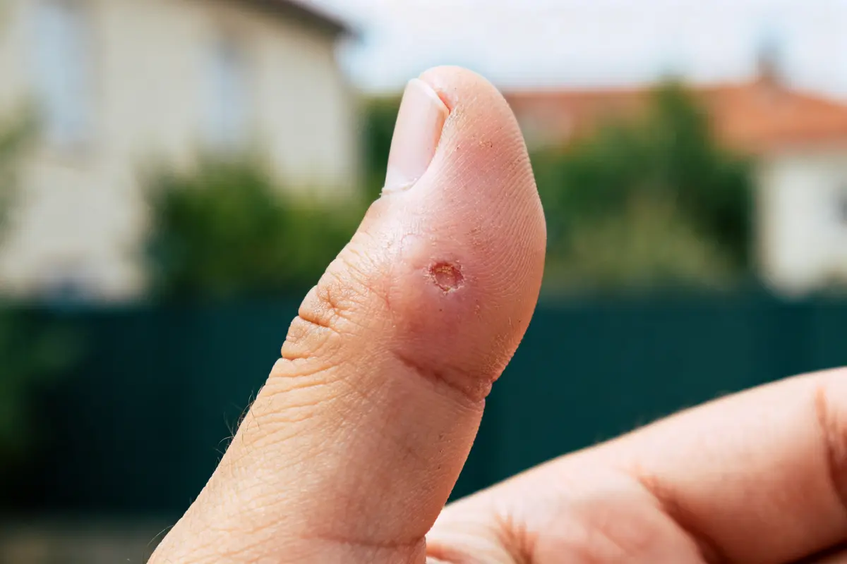 Gonflements des doigts : causes, symptômes et que faire ?