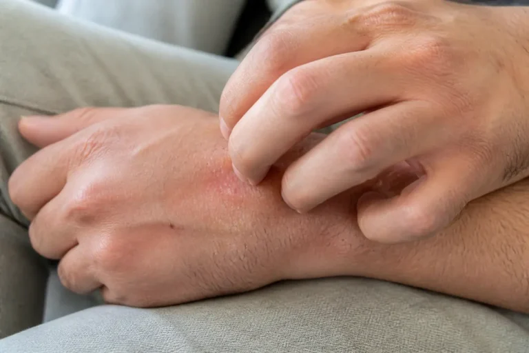 Homme avec main droite qui gratte rougeur sur sa main gauche posée doucement